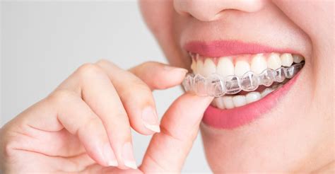 Are Clear Aligners As Effective As Traditional Braces Byford Smiles