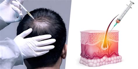 Premier Hair Loss Treatment For Healthier And Stronger Hair Premier