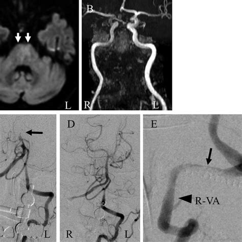 11 Ct Angiography Ab Ct Angiography Vertebral Artery R Va Download