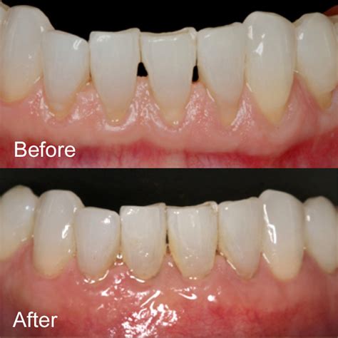 Pinhole Gum Therapy Oldsmar Dentistry