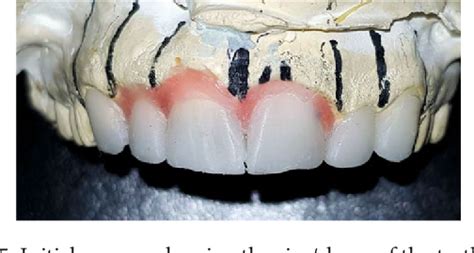 Figure 1 From Management Of A Rare Case Of Geminated And Fused Central