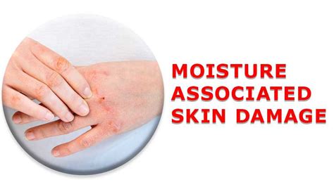 Best Treatment for Moisture Associated Skin Damage - Vince