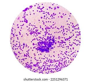 Synovial Fluid Cytology Plenty Wbc Microscopic Stock Photo 2251296371 ...