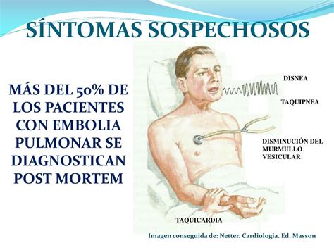 Ppt Esclerosis Vascular Embolia Pulmonar Hipertensión Pulmonar Edema Pulmonar Powerpoint