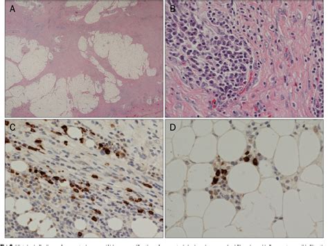 Figure From A Case Of Igg Related Sclerosing Mesenteritis