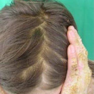 (PDF) Epidermolytic hyperkeratosis type NPS-3: A case report