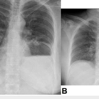 Plain Chest Radiographs Of The Patient A Plain Chest Radiograph