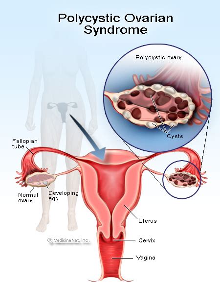 PCOS and amenorrhea - Women Health Info Blog