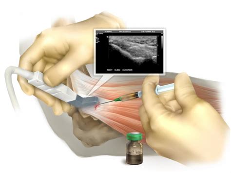 Orthocell Ortho Ati Autologous Tenocyte Implantation Platinum Medical