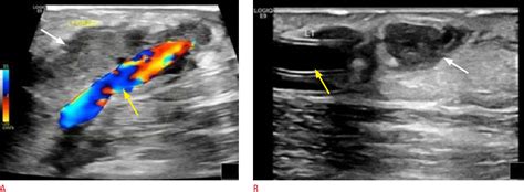 Figure From Multiparametric Ultrasound For Upper Extremity Dialysis