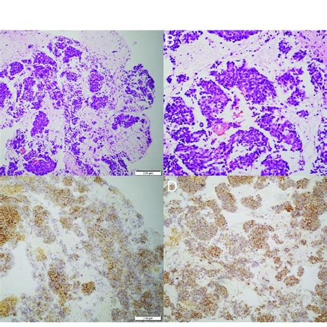 Pathological Examination And Immunohistochemistry A Biopsy Of