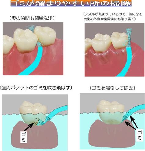 歯周ポケット洗浄｜歯周菌に殺菌液注入｜口臭対策｜口腔洗浄器細口型｜アプール