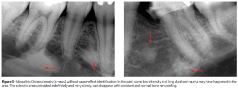 Idiopathic Osteosclerosis