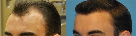 Hairline Reconstruction - 2500 FUE Grafts - Carolina Hair Surgery