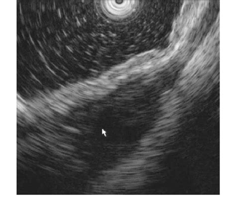 Endoscopic Ultrasonography Eus With A Mini Probe Of 12 Mhz Frequency Download Scientific