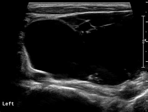 Cystic Hygroma Image