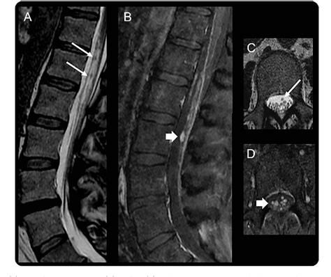 Figure 1 From Radiation Induced Spinal Nerve Root Cavernous