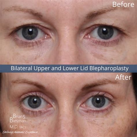 Eyelid Surgery Nashville Before And After Images