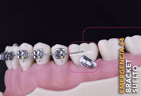 Gran engaño escribir eficacia alambre de brackets doblado un poco