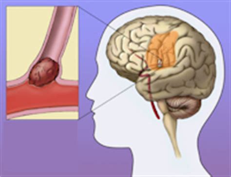 Stroke - Spine and Neurosurgery Center