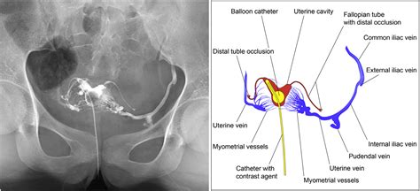 Venous Intravasation During Hysterosalpingography Chen The