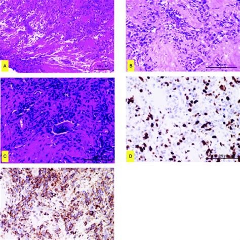 A Histopathological Findings Of The Biopsy In Hematoxylin Eosin Hande