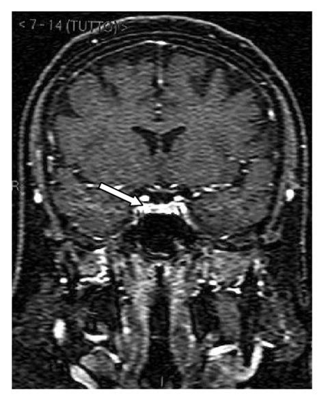 A Coronal Mri Scan Showing The Pituitary Microadenoma B Ct Scan