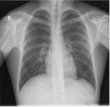 Radiology Photos St Lecture Chest Flashcards Quizlet