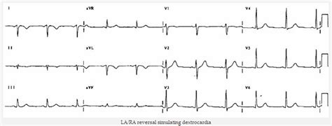 Mắc Sai điện Cực đổi Chiều Chuyển đạo Chi Ecg Tiêu Chuẩn Chẩn đoán