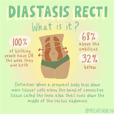 Diastasis Recti What Is It And Who Can It Affect In 2024 Diastasis