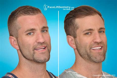 The Misaligned Jaw Symptoms And Treatment