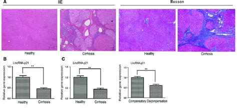 Lincrna P21 Levels Are Reduced In Human Liver Fibrosis A Download Scientific Diagram