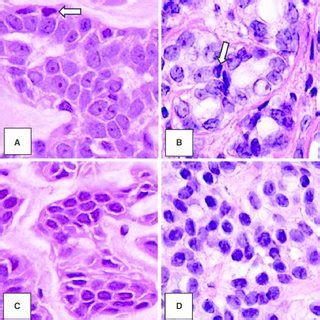 Polymorphous Sweat Gland Carcinoma Case Showing Tubular