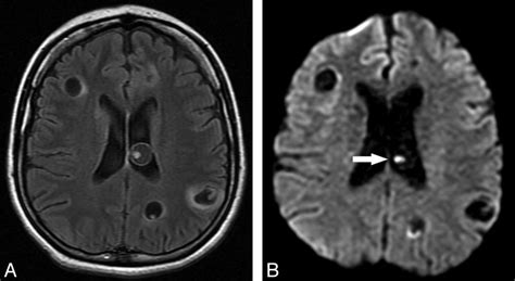 Tratamiento De La Cisticercosis Cerebral Por Endoscopía En Lima Perú Centro De Cirugía Por