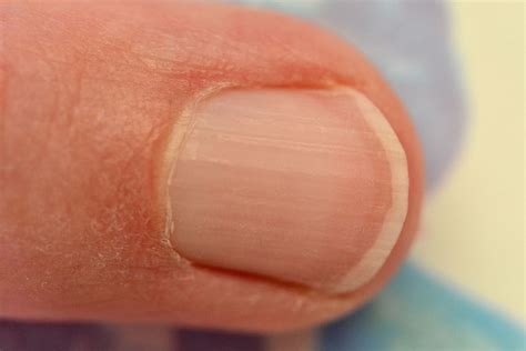 7 Common Nail Problems That Are Actually Symptoms Of Something Bigger