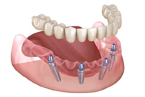 What Is The Difference Between All On 4 Implants And Regular Dental