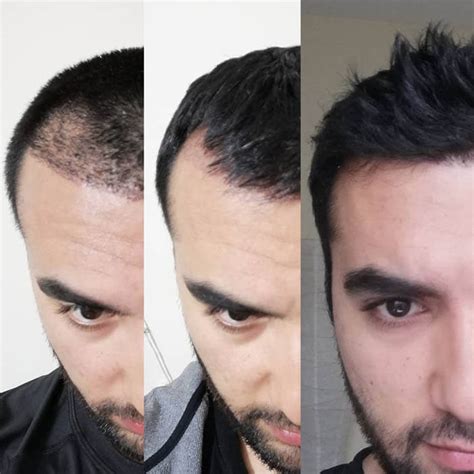 Hair Transplant In Iran The Success Rate Of Hair Transplant In Men And Women