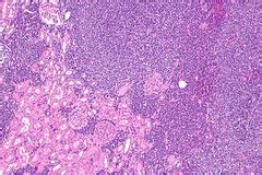 Marginal zone lymphoma - Libre Pathology