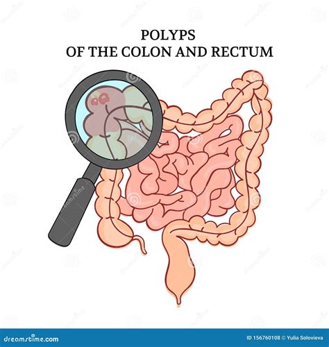 POLYPS Of The COLON Intestines Medicine Anatomy Vector Scheme Stock