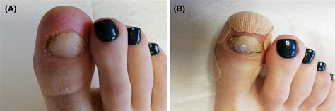 Two Case Studies Of The Treatment Of Simple Onycholysis With