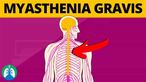 Myasthenia Gravis Medical Definition Quick Explainer Video YouTube