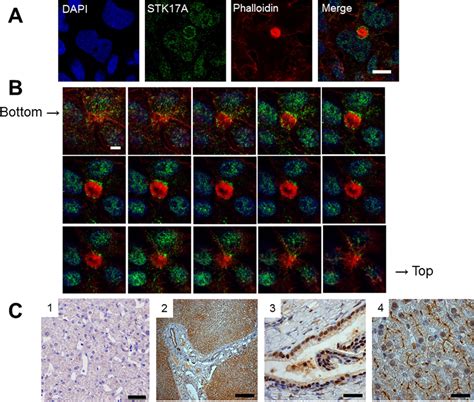 Bile Canalicular Localization Of STK17A In HepG2 Cells And Human