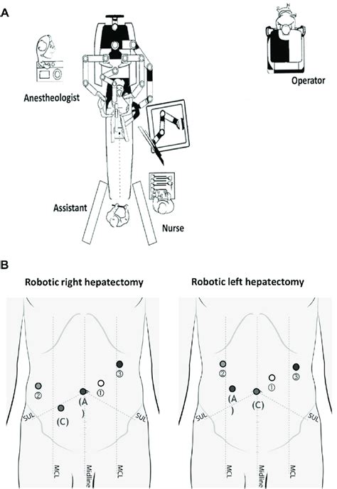 A Typical Operating Room Set Up For Robotic Hepatectomy B Port