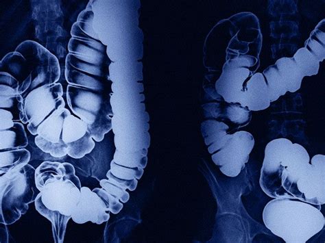 Crohns And Creeping Fat What To Know