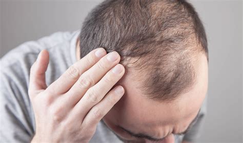 Genetic Vs Reactive Male Hair Loss Know The Difference Ds