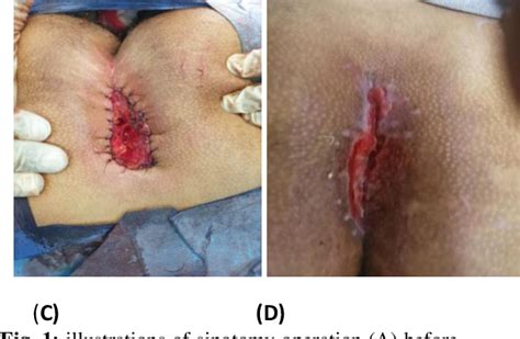 Figure 1 From Modified Sinotomy Versus Modified Limberg Flap In