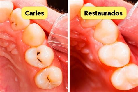 Caries Qué Son Cómo Saber Si Tiene Una Y Tratamiento Tua Saúde