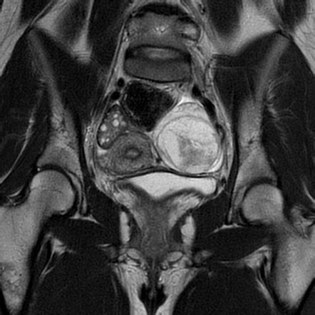 Hemorrhagic Ovarian Cyst Image Radiopaedia Org