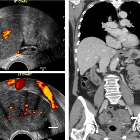 (PDF) Imaging staging of ovarian cancer