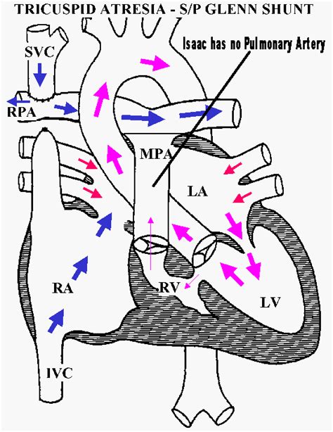 Bidirectional Glenn Shunt Procedure